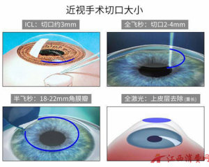近视手术想做就做?南昌华厦眼科划重点4条,搞定才能畅快摘镜